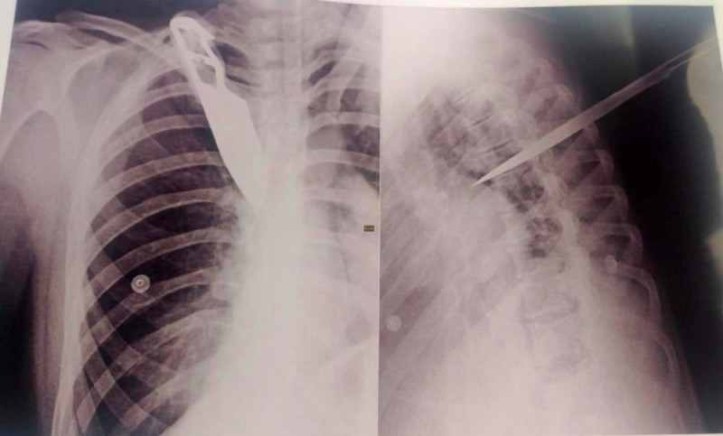 Imagem de raio-X mostra faca cravada nas costas de ex-companheira atingida por detento em 'saidinha' de fim de ano