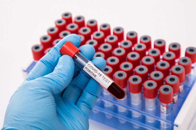 Cidades da microrregião registram novos casos positivos da Covid-19